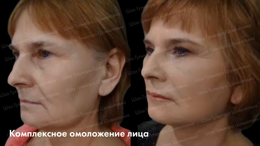 Комплексное омоложение лица